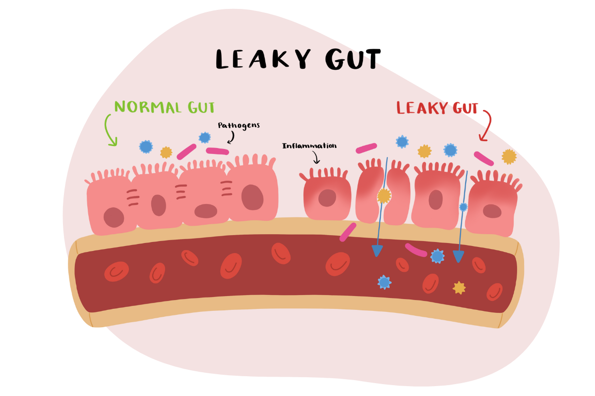 Leaky Gut